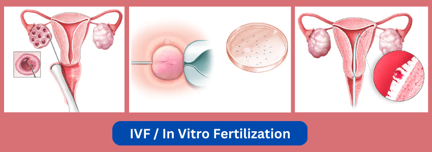 What is IVF or What is In Vitro Fertilization