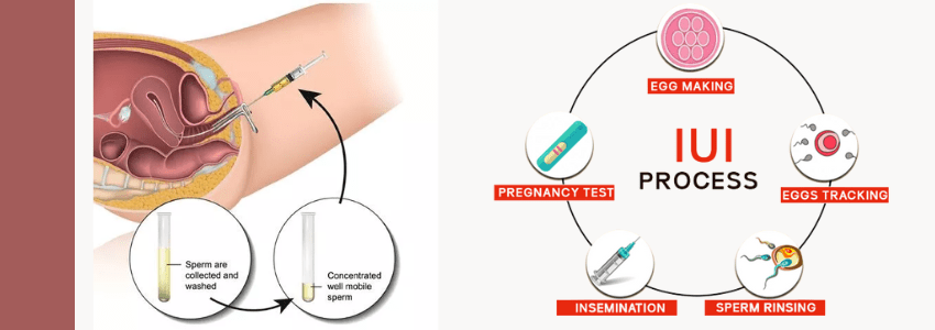 What is IUI Intrauterine Insemination - Risks, Success Rate and Uses
